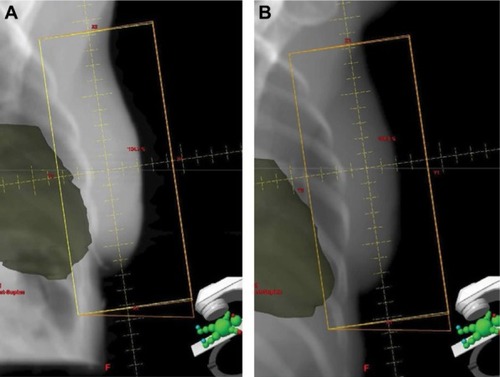 Figure 3 Digital reconstructed radiographs (DRR) generated from (A) free-breathing and (B) DIBH planning CT scans acquired from patient 1. The heart (shaded) moves inferiorly and posteriorly away from the tangential field with DIBH.