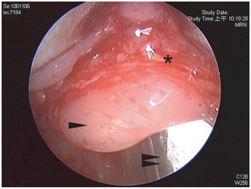 Figure 6 Deroofed cyst* wound, arrow shows epiglottis, double arrow shows endotracheal tube.