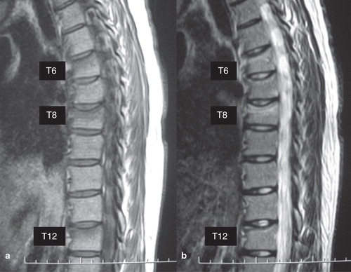 Figure 4. Magnetic resonance imaging (MRI) of the vertebrae in case 4. MRI showed low signal intensities on T1-weighted images (A) and high intensities on T2-weighted images (B) at the 6th, 8th, and 12th thoracic vertebrae.