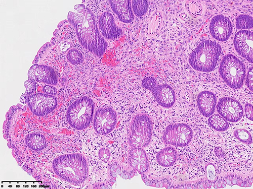 Figure 4 Pathological examination of the second colonoscopy biopsy.