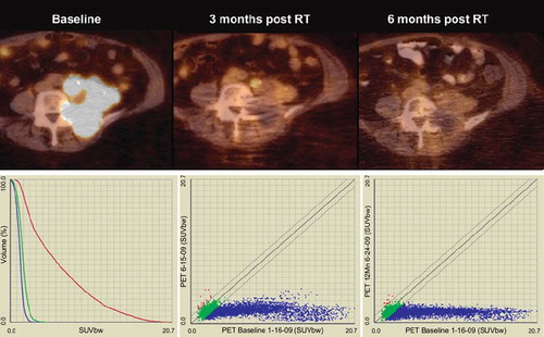 Figure 4. Upper figures represent PET-CT fusion images of a recurrent endometrial cancer at baseline, three months post completion of hypofractioned radiation therapy (45 Gy in 18 fractions), and at six months post radiation therapy. At three months of follow-up a significant response can be assessed visually, but minor uptake remains in a paraaortic tumor nodule. This uptake has resolved at six months, without evidence of tumor recurrence. The lower left figure shows graphs of SUV uptake distribution at baseline (red), first follow-up (green) and second PET-CT follow-up (blue). Not only is SUVmax decreased from a baseline value of 20.7 to 4.6 at three months, and to 3.2 at six months, but also the SUV distribution in general is further decreased with additional follow-up. The lower right figures show voxel by voxel response scatter plots, which indicate a significant response at three months, with further SUV declines later in follow-up. Notable here is again the excellent response of initial high SUV voxels, but also the observation that select voxels with initial low SUV show an increase at early follow-up (red dots; mid figure), with some normalization at later imaging (left figure). This increase in FDG uptake in initial low SUV voxels is preliminarily interpreted to represent inflammatory response with unknown prognostic significance.