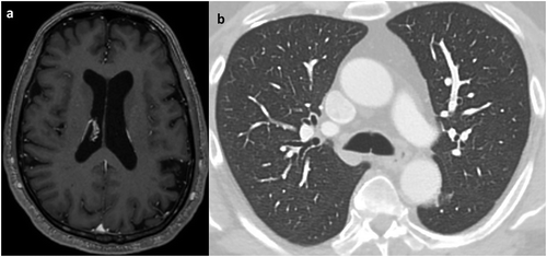 Figure 3. Magnetic resonance imaging of the brain (a) and computed tomography of the chest (b) obtained following completion of anti-tuberculous therapy demonstrated resolution of previously present abnormalities