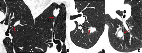 Figure 1 Four types of bronchial cutoff signs. (A) Type I: the lesion grows along the outline of the bronchus with a noted truncation of the proximal lumen (red arrow). (B) Type II: bronchus (red arrow) is obstructed abruptly by the lesion. (C) Type III: bronchus (red arrow) penetrates into the lesion with tapered narrowing and interruption. (D) Type IV: bronchus (red arrow) runs around the periphery of the lesion and is displaced, compressed, and narrowed by it.