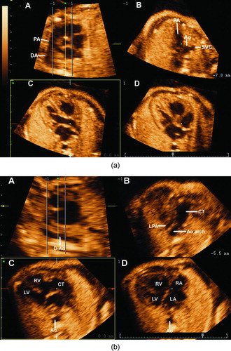 Figure 4.  (a) A novel algorithm using tomographic ultrasound imaging (TUI) allows for the simultaneous visualization of the short axis of the aorta in panel A, the three vessel and trachea view in panel B, the long axis of the left outflow tract in panel C and the four-chamber view in panel D. (b) The application of this algorithm to the present case of truncus arteriosus demonstrates a large ventricular septal defect (VSD) in the four-chamber view in panel D. Panel C displays a large vessel overriding the VSD. Of note, the root of the aorta is not visualized in panel A, which corresponds to the short axis of the heart. This indicates that the anatomic orientation of the common arterial trunk is similar to that of a normal pulmonary artery. Panel B displays the common trunk giving rise to the left pulmonary artery (LPA) and the aortic arch (Ao arch).