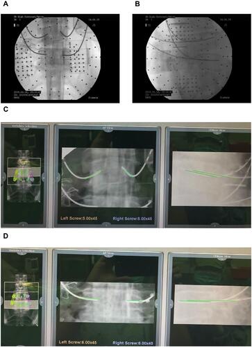 Figure 3 Secondary registration. (A) Anteroposterior view of the guided pin inserted with assistance of the robotic system. (B) Oblique view of the guided pin inserted with assistance of the robotic system. (C and D) Secondary registration (Reregistration): After implantation of the Kirschner-wire, anteroposterior and oblique radiographic plain films are obtained again. Using the same system, registration with the preoperative computed tomography images is again performed. Then, the deviation of the guided pins is evaluated compared with the original trajectory designed by the robotic system preoperatively.