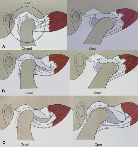 Figure 2 Sketch map of temporomandibular joint: normal TMJ(A); disc displacement of TMJ with reduction(B); disc displacement of TMJ without reduction(C).