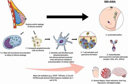 Figure 2. Pathophysiology of breast implant illness (a form of autoimmuneinflammatory/autoimmunityinflammatory syndrome induced by adjuvants).