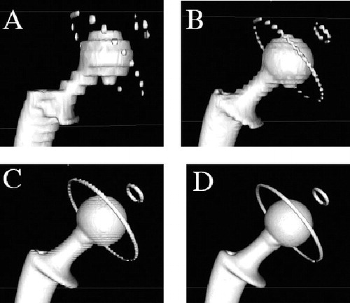 Figure 1. 3-dimensional image reconstructions of a CT-scanned all-poly acetabular component assembled with its matching femoral stem and 28-mm diameter head. The images were produced using the surface rendering function in OsiriX and illustrate the ‘partial voluming effect’ that increases with thickness of CT section slice: A. 5 mm; B. 2.5 mm; C. 1.25 mm; D. 0.625 mm.
