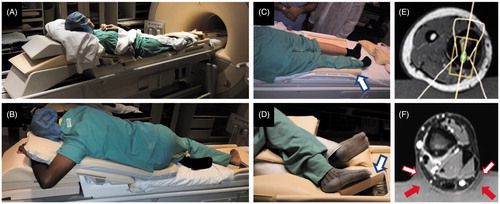 Figure 2. Patient positioning and ultrasound coupling for extremity osteoid osteoma treatments. Patient positioning was feasible in all eight patients. (A,B) extension of the HIFU table was necessary to support the upper body during lower extremity treatment. (C,D) pre-treatment positioning helped identify pressure spots, enabled pre-planning of sonications, and provided guidance for patient positioning. Yellow padding 4 cm in thickness (C&D, hollow blue arrows) was used in place of gel in pre-anaesthesia patient positioning. (E,F) ultrasound coupling gel pads were cut, carved and sometimes combined to ensure HIFU coupling free of air-water interfaces. Note that the outline of the HIFU beam passes directly into the limb while avoiding air through either (E) conformably carved gel pad, or (F) wedge-shaped gel pads (solid red arrows) placed on both sides of the limb, with 1:2 ultrasound gel:water dilution creating continuous coupling (hollow red/white arrows).
