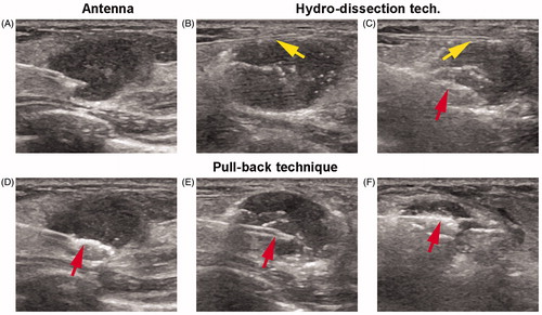 Figure 1. Microwave ablation (MWA) procedure under ultrasound (US) guidance (A 18-year-old woman with a right breast fibroadenoma of 2.5 × 1.3 × 1.5 cm in size). (A) US guidance showed the accurate placement of the antenna tip in the tumour at the beginning of MWA session; (B, C) Hydro-dissection technique: PTC needle (yellow arrows) was firstly inserted into the interval between tumour margin and adjacent tissues to infusion of saline. Then MW antenna (red arrow) was inserted into the tumour for ablation; (D–F) Pull-back technique: antenna tip was firstly inserted into the deepest site of tumour for ablation (red arrow in D). Then pull back till the bottom section was completely ablated. After that, antenna tip was again inserted to ablate the centre section (red arrow in E). And again, antenna tip was inserted to ablate the top section (red arrow in F). Repeatedly, the ablated zone was through dots, lines, planes, and solids till to completely cover the entire tumors.