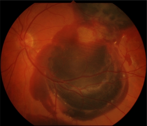Figure 2 Submacular hemorrhage of case 3 pre-treatment.