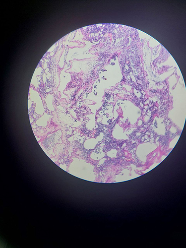 Figure 5 Histologic section shows lymphatic spaces lined by attenuated endothelium and separated by thin fibrous stroma containing lymphocytes.