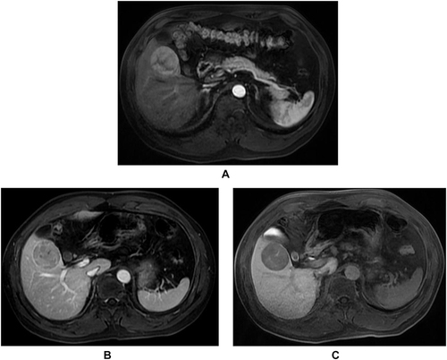 Figure 4 MR images of a 48-year-old man with chronic hepatitis B infection, categorized as LR-5 HCC without MVI and non-recurrence. (A) Non-rim arterial phase hyperenhancement (APHE) on the arterial phase. (B) Non-peripheral washout on the portal venous phase. (C) The lesion of hypointense on the HBP image.