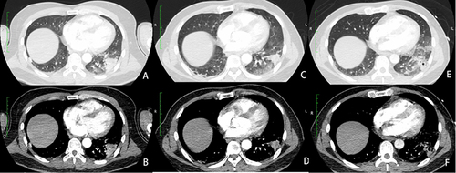 Figure 1 (A and B) Chest CT showed consolidation of the outer basal segment of the left lower lobe, measuring 2.8×3.0× 3.5 cm, (C and D) Chest CT showed a reduced consolidation lesion measuring 2.0 cm × 2.6 cm × 3.0 cm, with ground glass density foci and cords surrounding the lesion, (E and F) Chest CT showed an increase in the size of consolidation to 2.0 cm × 2.7 cm × 3.1 cm and bilateral ground-glass opacities.