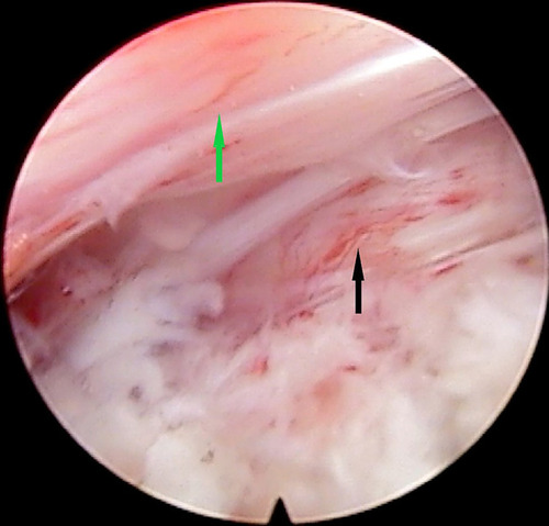 Figure 9 The operation field under endoscopy in PETD. The contralateral L5 nerve root (black arrowhead) is accessible and can be easily decompressed. The green arrowhead demonstrates the dural sac.