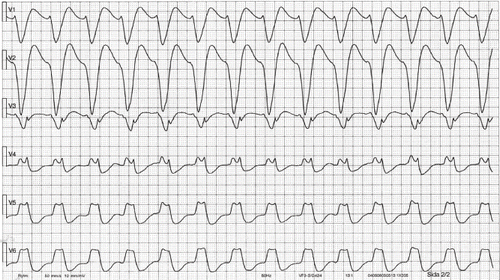 Fig. 2.  Precordial ECG leads recorded at 5:05 am (case 1), displayed tachycardia, 164/minute, with a markedly widened QRS complex (194 ms); most likely ventricular tachycardia.