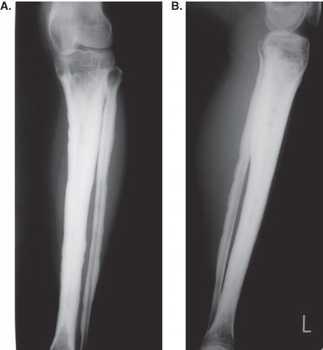 Figure 1.  Anteroposterior (A) and lateral (B) radiograms of the left lower leg show diaphyseal widening and cortical thickening of the tibia and fibula.