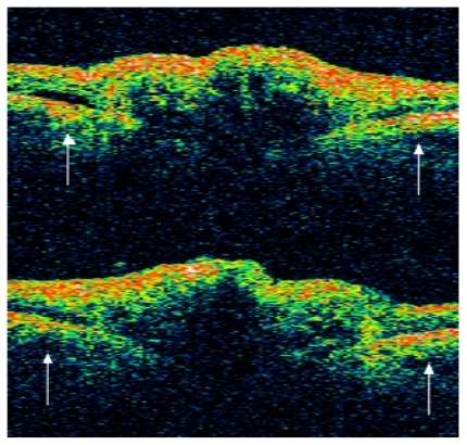Figure 2 Stratus OCT 3 (Stratus Optical Coherence Tomography 3; Carl Zeiss Meditec, Dublin, CA, USA). The Stratus OCT shows an elevated optic nerve head with a signal-poor region below the surface and a peripapillary serous detachment (white arrows) in both eyes.