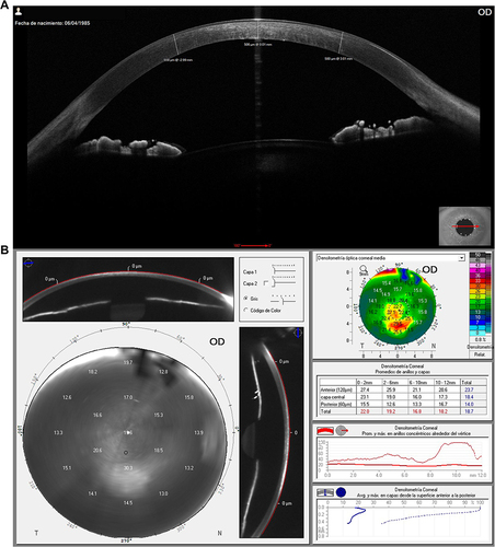 Figure 3 (A) Postoperative anterior segment optical coherence tomography of the case presenting an extreme flattening of 11.5D in the steeper keratometry; (B) Pentacam densitometric values of the same patient.