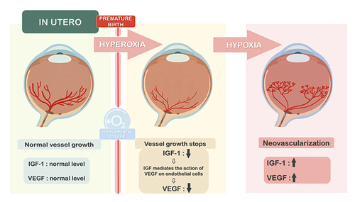 Figure 2 Schematic representation of the interaction between oxygen, IGF-1, VEGF and the development of retinal vessels in ROP.