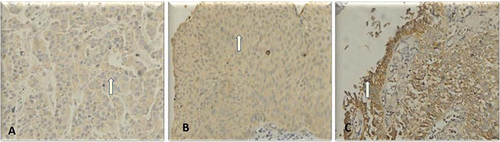 Figure 2 Distribution of CD24 in urothelial cells of urothelial bladder carcinomas. (A) CD24 + weak distribution 10–50%; (B) CD24 + moderate distribution for more than 80%; (C) CD24 + strong distribution 50–80%. Arrows indicate the CD24.