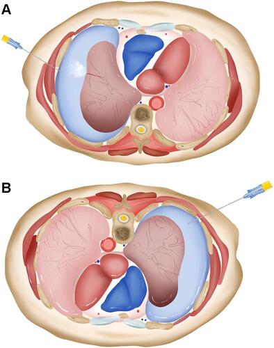 Figure 1 The model of biopsy side down aspiration for treatment of pneumothorax. (A) Air tends to leak when aspiration is performed near the initial biopsy site because of increased alveolar-to-pleural pressure gradient. (B) The “dependent atelectasis”, which occurs in biopsy side down position, provides a physical barrier to further air leakage, and the aspiration does not increase the alveolar-to-pleural pressure gradient around the puncture site.