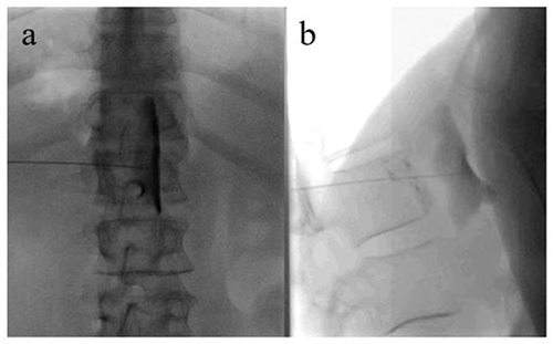 Figure 1 Celiac plexus neurolysis in a patient with pancreatic cancer-related abdominal pain.