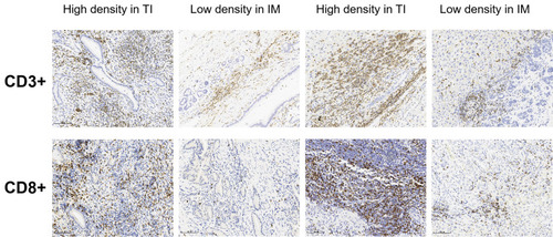 Figure 2 Representatively images of immunohistochemistry. According to the cut-off thresholds, tumor-infiltrating lymphocytes density of CD3+ and CD8+ at TI and IM were categorized into high density or low density. Each patient’s Immunocore obtained by the sum of four binary score values.