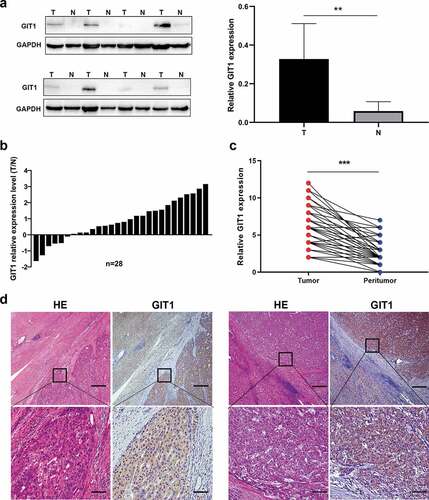 Figure 2. Expression pattern of GIT1 in HCC tissues