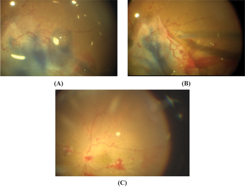 Figure 1. Surgical steps of case # 6 (right eye with TRD and ERM of 49-year-old female patient suffering type 1 diabetes for 14 years) in (group A) (A) Injection of the vital dye under the PFCL. (B) Bimanual dissection of fibrovascular membranes. (C) after removal of fibrovascular proliferations.