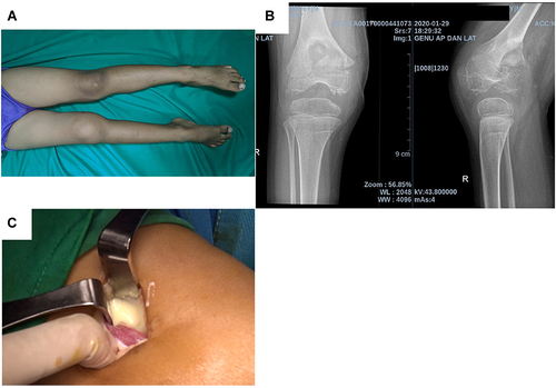 Figure 2 (A) Pain and swelling on right knee of 6 years old boy since 2 months; (B) X ray of the right knee showed distal metaphyseal part of distal tibia and already involving the knee joint; (C) We found casseous necrosis and pus intraarticularly.