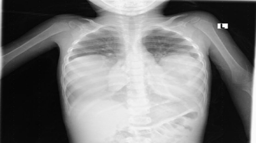Figure 1 PA chest x-ray showed bilateral lung mass with opacification of the right and left hemithorax.