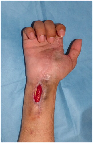 Figure 1. Appearance of the right wrist in the first visit to our outpatient clinic.
