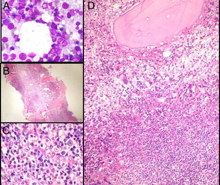 Figure 1. (A) Bone marrow imprint smears show a mild excess of small-sized lymphoid cells (MGG-Giemsa ×1000). (B) Hypercellular bone marrow biopsy shows large collections as well as an interstitial excess of lymphoid cells (H&E ×100). (C) Larger nucleolated neoplastic lymphoid cells are scattered amidst reactive lymphocytes (H&E ×1000). (D) A non-paratrabecular lymphoid aggregate comprised of predominantly small lymphoid cells. A few histiocytes and normal hemopoietic elements are also present (H&E ×200).