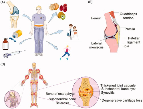 Figure 1. Introduction of OA. (A) Current OA treatment, including surgery, drugs, diet, patient education, and exercise. (B) Normal parasagittal section of the knee. (C) Schematic illustration of osteoarthritis. The pathobiology of OA and potential occurring sites in human body. Compared to (B), it demonstrates that OA is a disease that affects the entire joint structure, including the articular cartilage, synovium, subchondral bone, joint capsule, and other components of the joint.