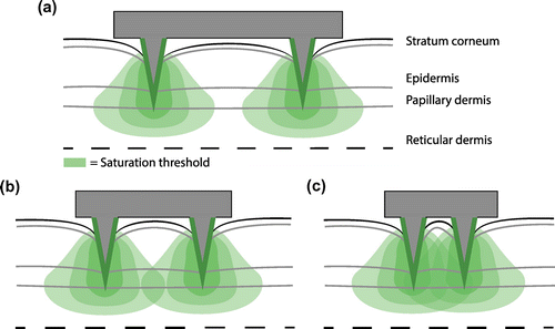 Figure 9. The volume in which cells are activated was dependent on the spacing between microneedles, as visualized in these two-dimensional drawings of a large (a), optimal (b), and small (c) distance between microneedles. The area in which the saturation exceeds the saturation threshold is largest for the optimal spacing.