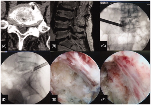 Figure 1. a typical case of PELD. Notes: (A) coronal CT shows L5/S1 right FLDH. (B) sagittal MRI shows L5/S1 FLDH. (C) and (D) intraoperative channel X-ray images. (E) and（F）Exposure of exiting nerve root.