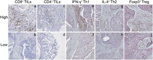 Figure 1. Representative pictures of TILs infiltration density by immunohistochemical staining (×200). CD8+ TILs with high (a) and low (b) infiltration density. CD4+ TILs with high (c) and low (d) infiltration density. IFN-γ+ Th1 with high (e) and low (f) infiltration density. IL-4+ Th2 with high (g) and low (h) infiltration density. Foxp3+ Treg with high (i) and low (j) infiltration density.