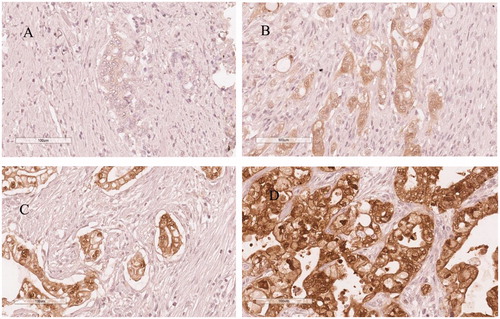 Figure 1. Representative immunohistochemical images of galectin 4 expression in pancreatic cancer, (A) negative expression, (B) weak expression, (C) moderate expression, (D) strong expression.