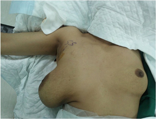 Figure 1 Patient in supine position before the shunt surgery and after aspiration of the cyst.