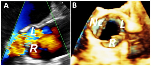 Figure 1. (A) A 120° Long-axis view (2D TEE) shows a broad jet of aortic regurgitation. (B) 3D volume of the aortic root (from reference [Citation8]).