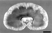 FIG. 1 Kidney. Numerous cysts are present in the cortex. Bar = 1 cm.