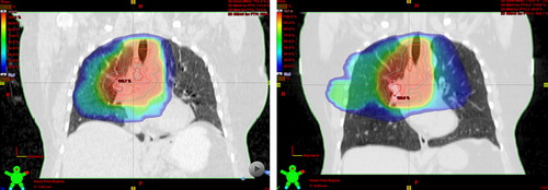 Figure 1. Dose distribution on a free breathing midventilation scan (left side) resulted in MLD of 21.1 Gy and V20 of 40.5%.which exceeded the lung tissue constraints. Treatment plan on a DIBH scan (B right side) decreased MLD to 19.7 Gy and V20 to 35.8%. Lung volume increased by 67%.