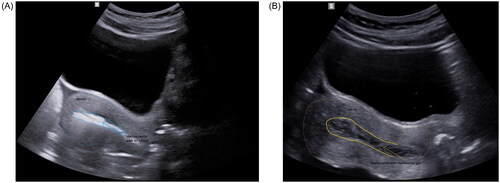 Figure 1. Vaginal ultrasound images of the uterus after hysteroscopic adhesiolysis with final instillation of (A) 4DryField® PH (group A) or (B) Hyalobarrier® gel (group B).