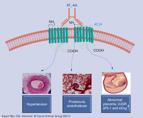 Figure 3. Angiotensin receptor agonistic autoantibodies induce multiple features of preeclampsia in pregnant mice via AT1 receptor activation.Recent evidence indicates that AT1-AA injection into pregnant rodents (mice or rats) results in multiple feature of preeclampsia, including IUGR. This experimental model of autoantibody-induced preeclampsia and IUGR in pregnant rodents provides important experimental opportunities to test the ability of various strategies to prevent or reverse autoantibody-induced clinical features associated with preeclampsia.AT1-AA: Angiotensin receptor agonistic autoantibody; AT1R: Angiotensin II receptor; IUGR: Intrauterine growth retardation.