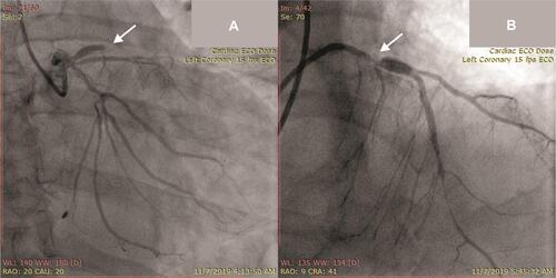 Figure 2 (A) Total occlusion at proximal segment of left anterior descending artery from coronary angiography pre-primary PCI (arrow); (B) final result after primary PCI showing significant residual stenosis at proximal left anterior descending artery (arrow).