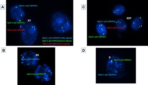 Figure 1 (A) Nuclei of three blastomeres using cytocell aquarius kit (REF: LPA 002) for probe combination; X chromosome centromere, Xp11.1- q11.1 (DXZ1) Green, Y chromosome centromere, Yp11.1-q11.1 (DYZ3) Red and 18 chromosome centromere, 18p11.1- q11.1 (D18Z1) Blue, each showing a single green, a single red and two blue signals representing a normal male embryo. (B) Nuclei of two blastomeres each showing two green and two blue signals representing a normal female embryo. (C) Nuclei of four trophoblasts each with two blue signals, two green signals and one red signal representing an XXY embryo. (D) A nucleus of a blastomere showing two blue signals and a single green signal representing a Turner syndrome embryo (monosomy X).