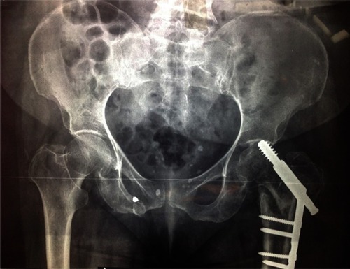 Figure 1 Postoperative radiography of a 95-year old patient that had undergone reconstructive total hip arthroplasty (THA).