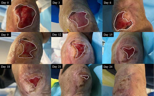 Figure 2 Representative images of the healing process in case 2.