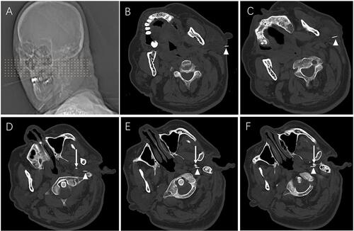 Figure 1 PRF procedures. (A) Location for puncture. (B–F) Consecutive CT scans showing the puncture needle gradually reaching the medial edge of styloid process. Patients were placed in a supine position with head slightly turned contralaterally. White arrows indicate the needle, white triangles indicate the styloid process.
